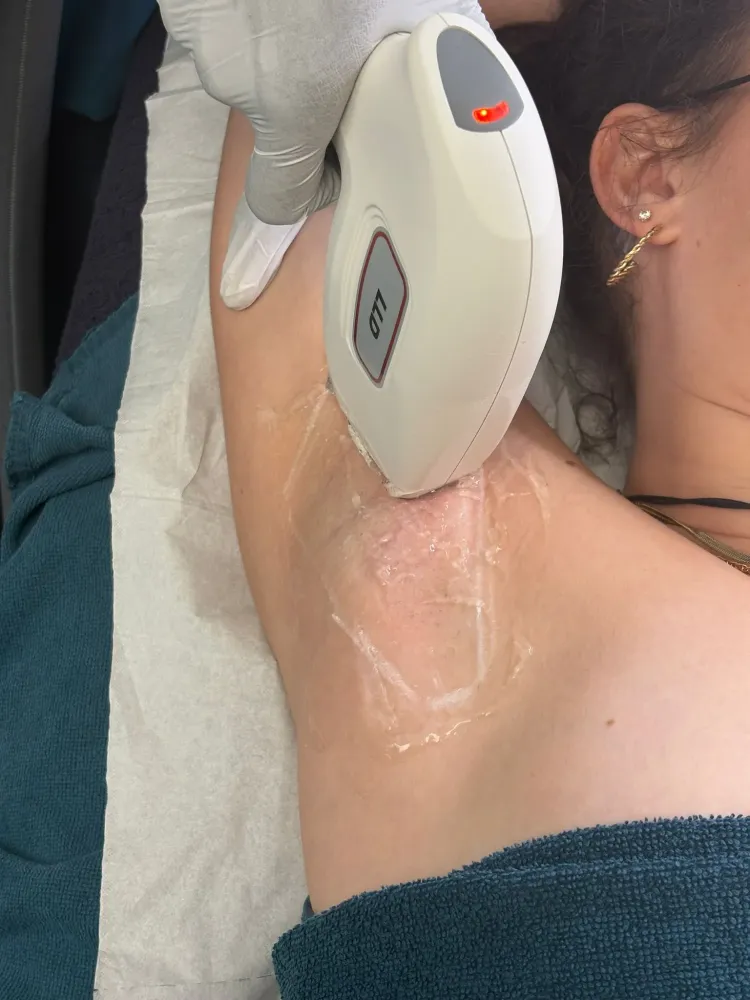 Épilation laser diode pour femme à Marseille